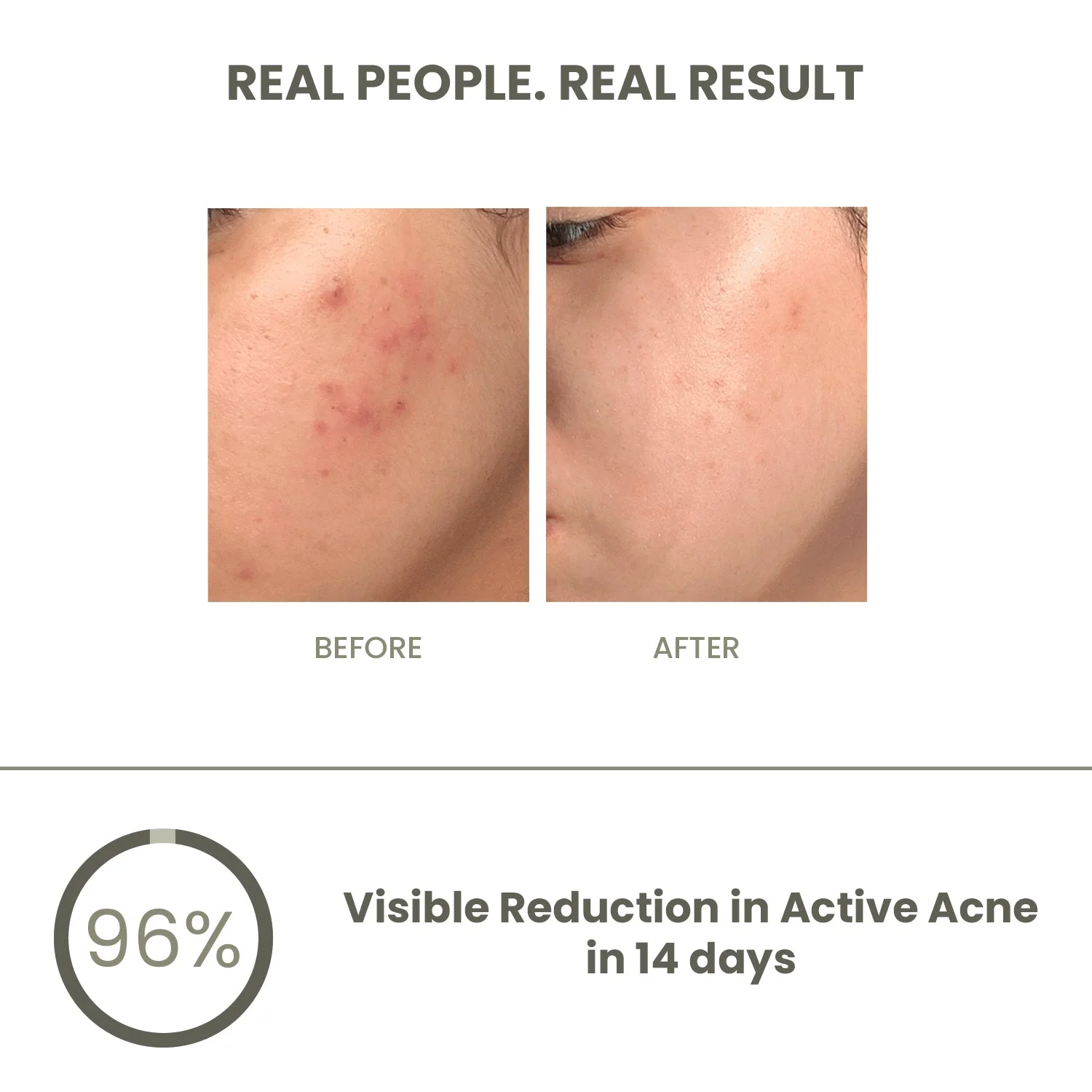 Pimple  Control Combo Clear Glowing Skin - Image 3